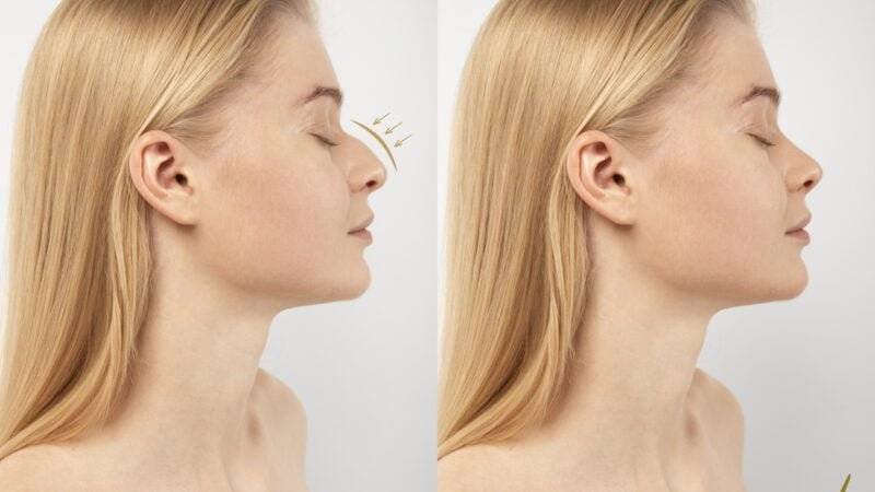 woman-getting-ready-nose-job-surgery